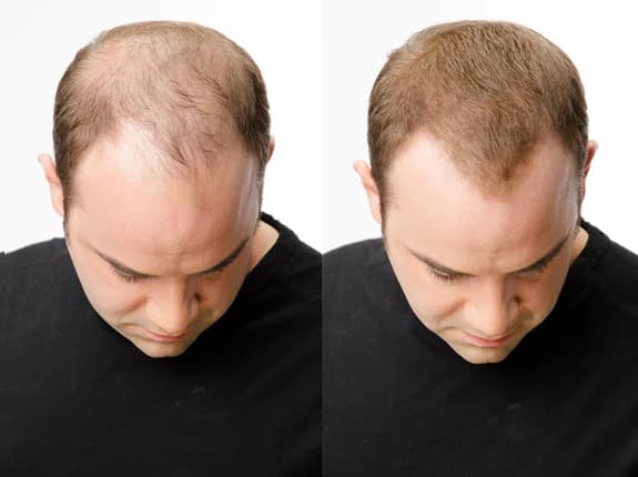 Så fungerar hårfibrer – vetenskapen bakom omedelbart fylligare hår