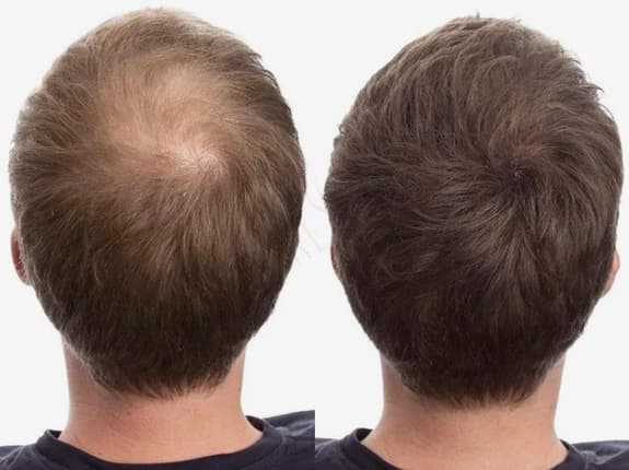 Håravfall och självkänsla – så tar du tillbaka känslan av kontroll